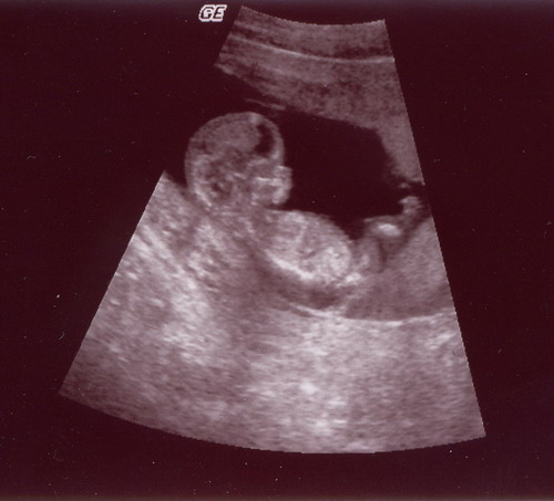 12. rasedusnädalal ultraheliuuringu käigus tehtud normaalse arenguga loote UH-pilt.